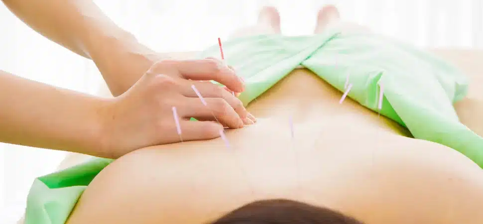 tecnica de acupuntura em paciente de costas