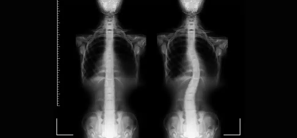 Raio-x de uma coluna normal, e ao lado o raio-x de uma coluna com escoliose, curvada